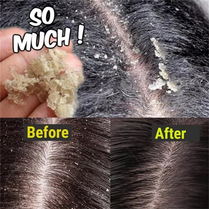 Fast Anti Dandruff Hair Treatm - огляд і ціна Hair Care Dandruff